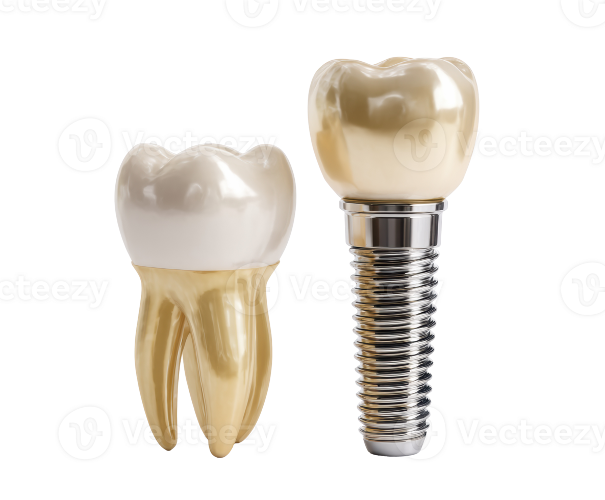 Dental implant and restoration concepts for oral health png