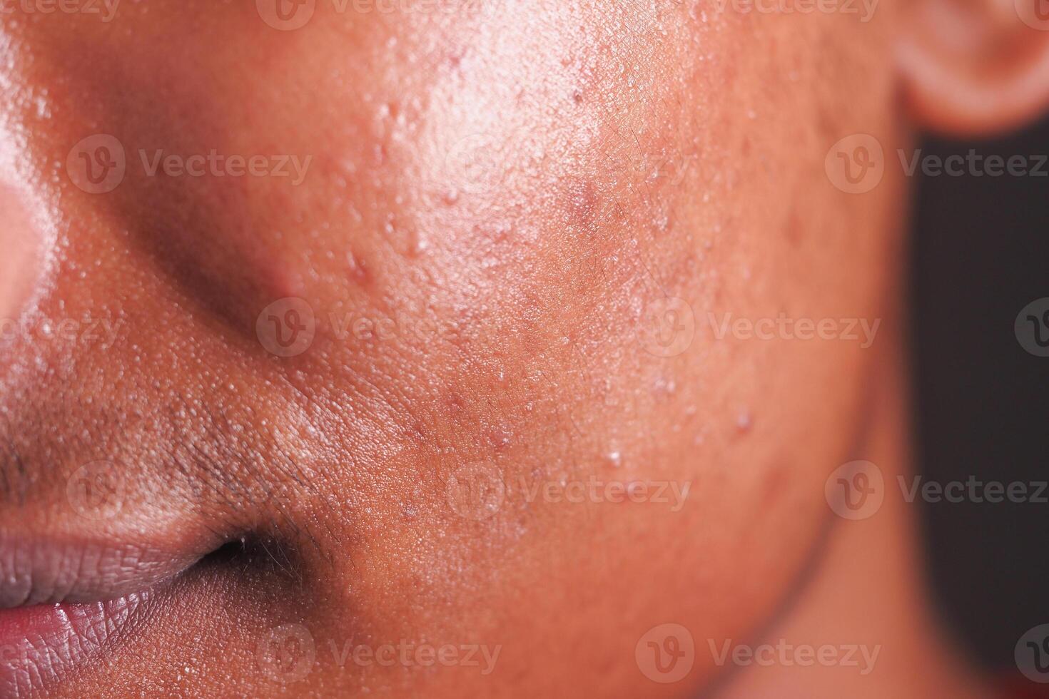Skin close-up showing texture and blemishes on a face photo