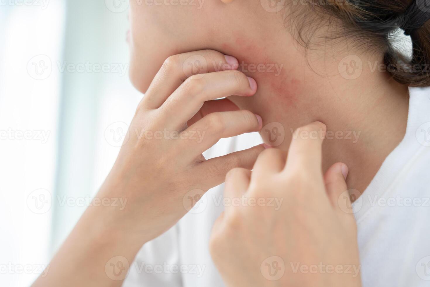 skin problem and beauty Young woman scratch body has itchy skin from skin allergic, steroid allergy, sensitive skin, red from sunburn, chemical allergy, rash, insect bites photo