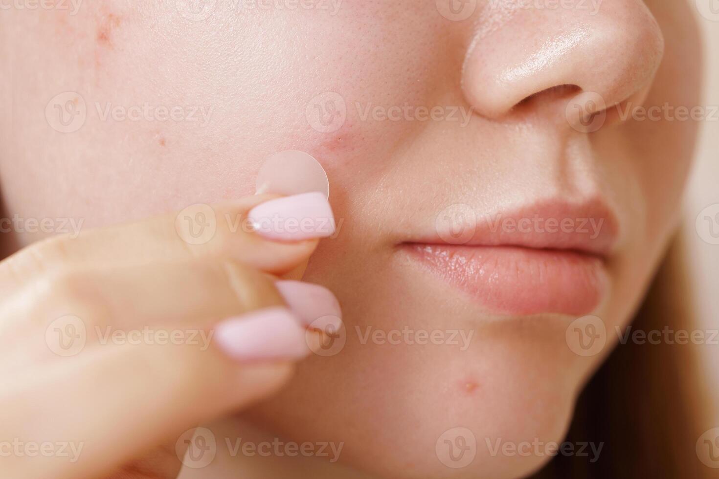 Closeup Woman Applying Acne Patch on Face Skincare Treatment with Hydrocolloid Pimple Patch photo