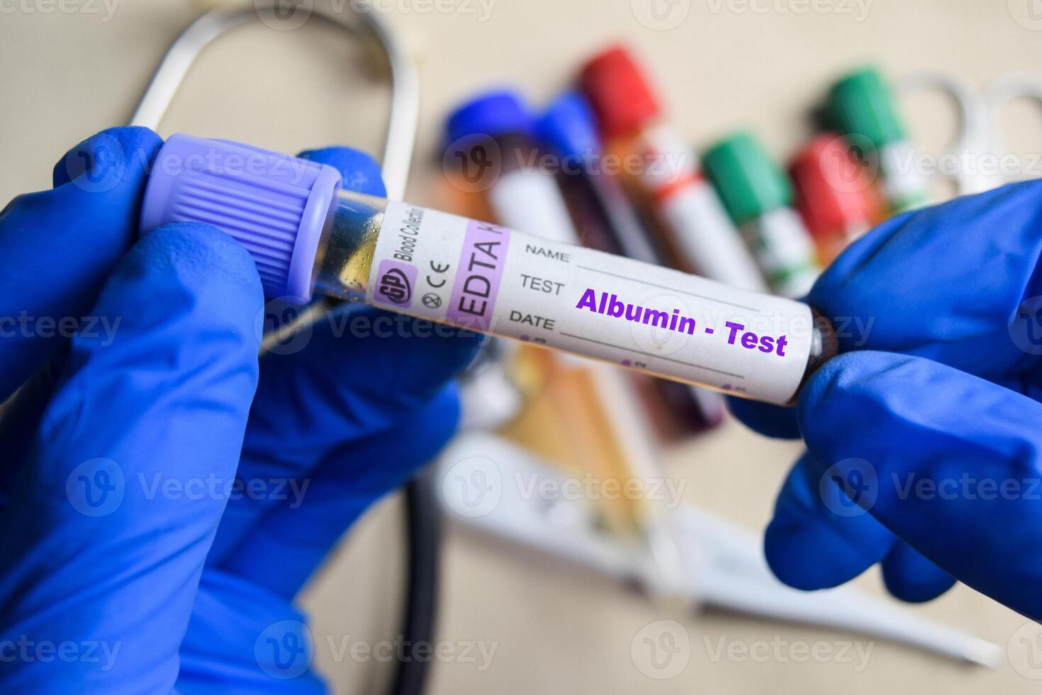 Albumin- Test with blood sample in blue gloved hands. healthcare or Medical concept photo
