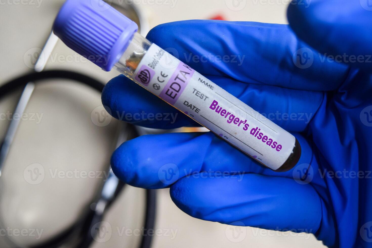 Thromboangiitis obliterans. Buergers Disease - Test with blood sample in blue gloved hands. healthcare or Medical concept photo