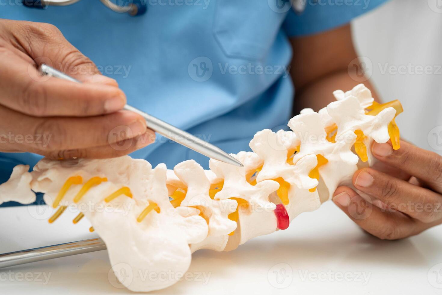 doctor holding spinal nerve and bone model, Lumbar spine displaced herniated disc fragment for treatment orthopedic photo