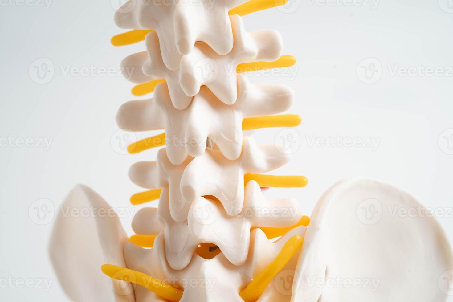 Spinal nerve and bone, Lumbar spine displaced herniated disc fragment, Model for treatment medical orthopedic photo