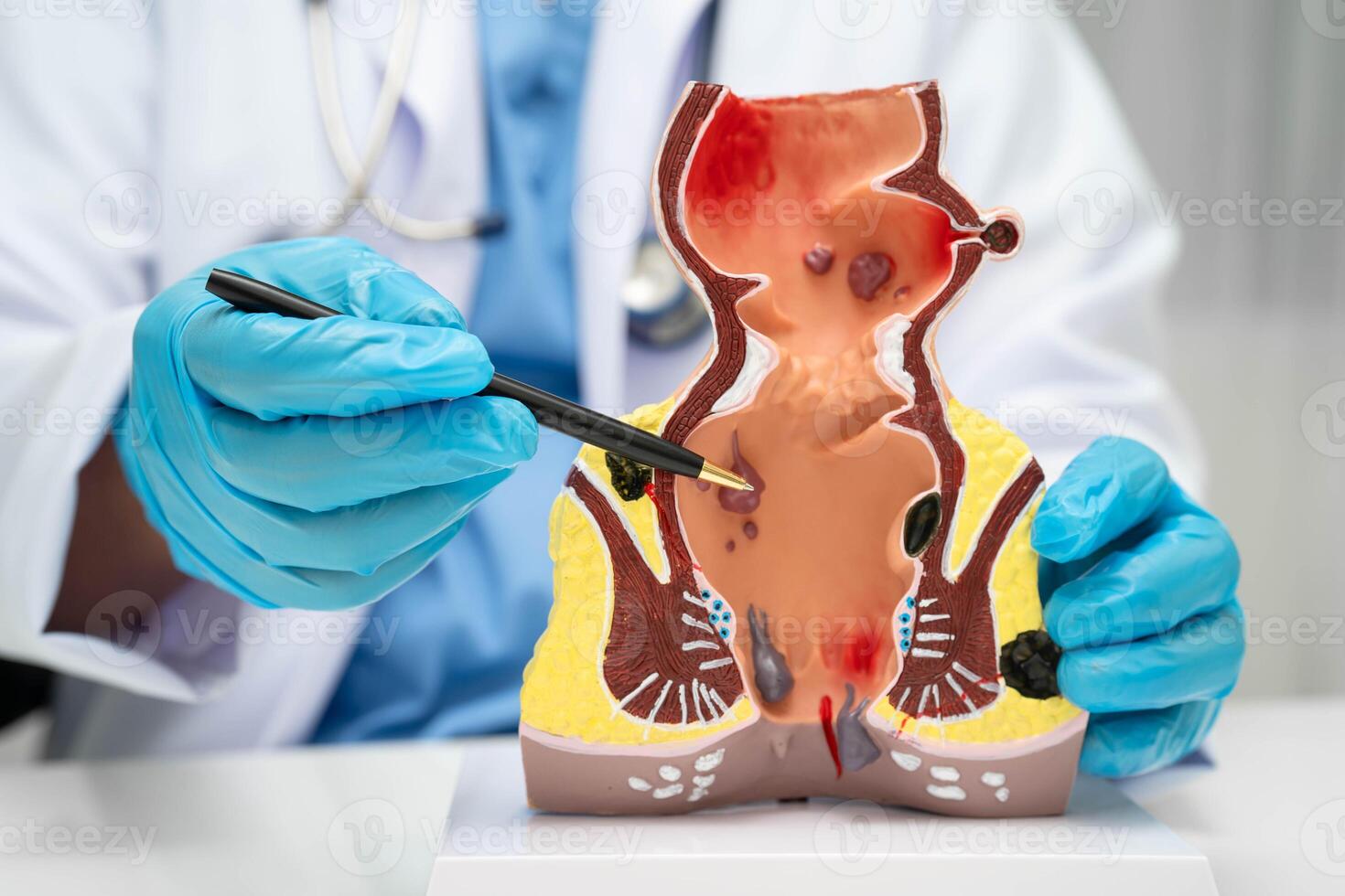 doctor rectum hemorrhoid human anatomy model at hospital, inflamed vascular structure. photo