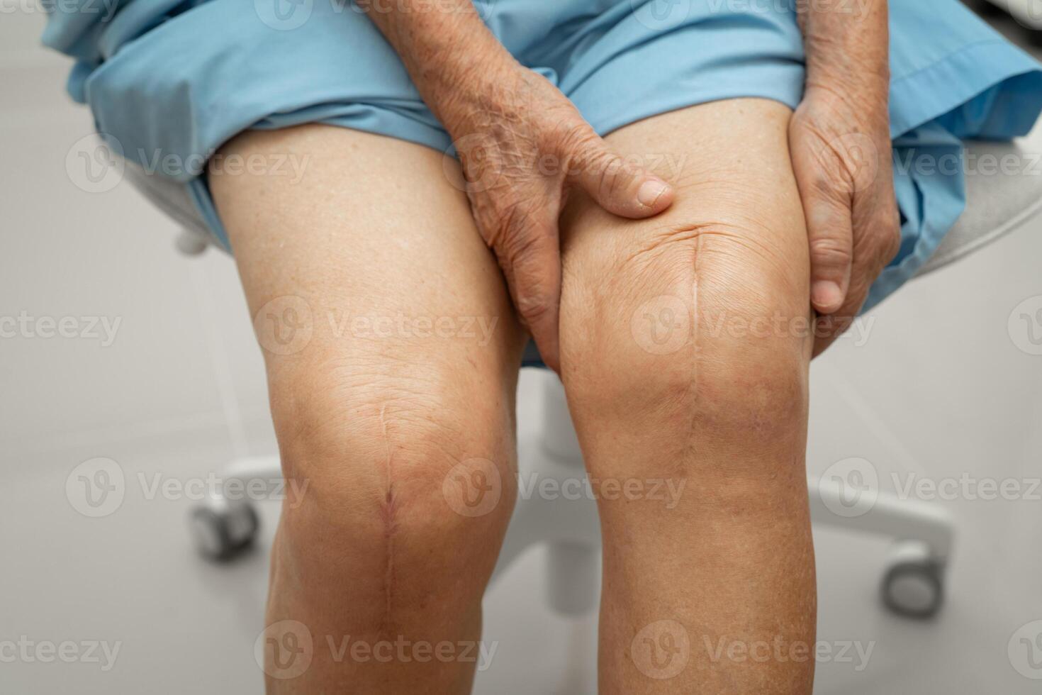 woman patient with scar knee replacement surgery photo