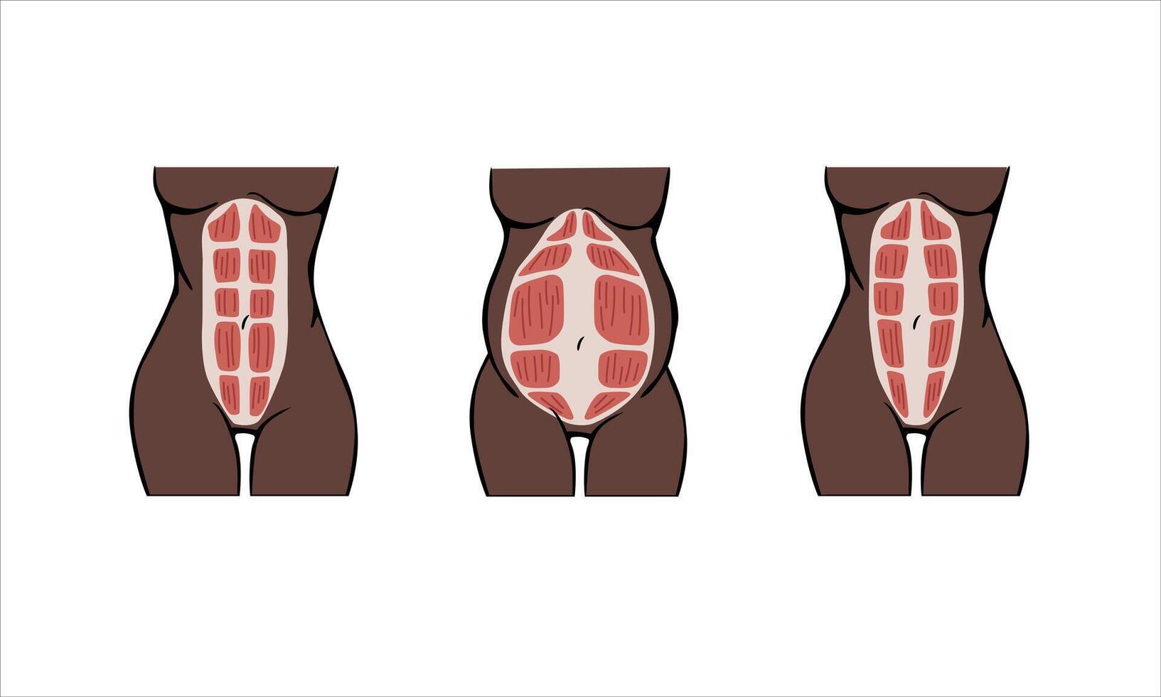 Different types of Diastasis. Dark-skinned woman. Diastasis in a woman before, during and after pregnancy. The anatomy of a Woman. A woman's muscular corset before and after childbirth. vector