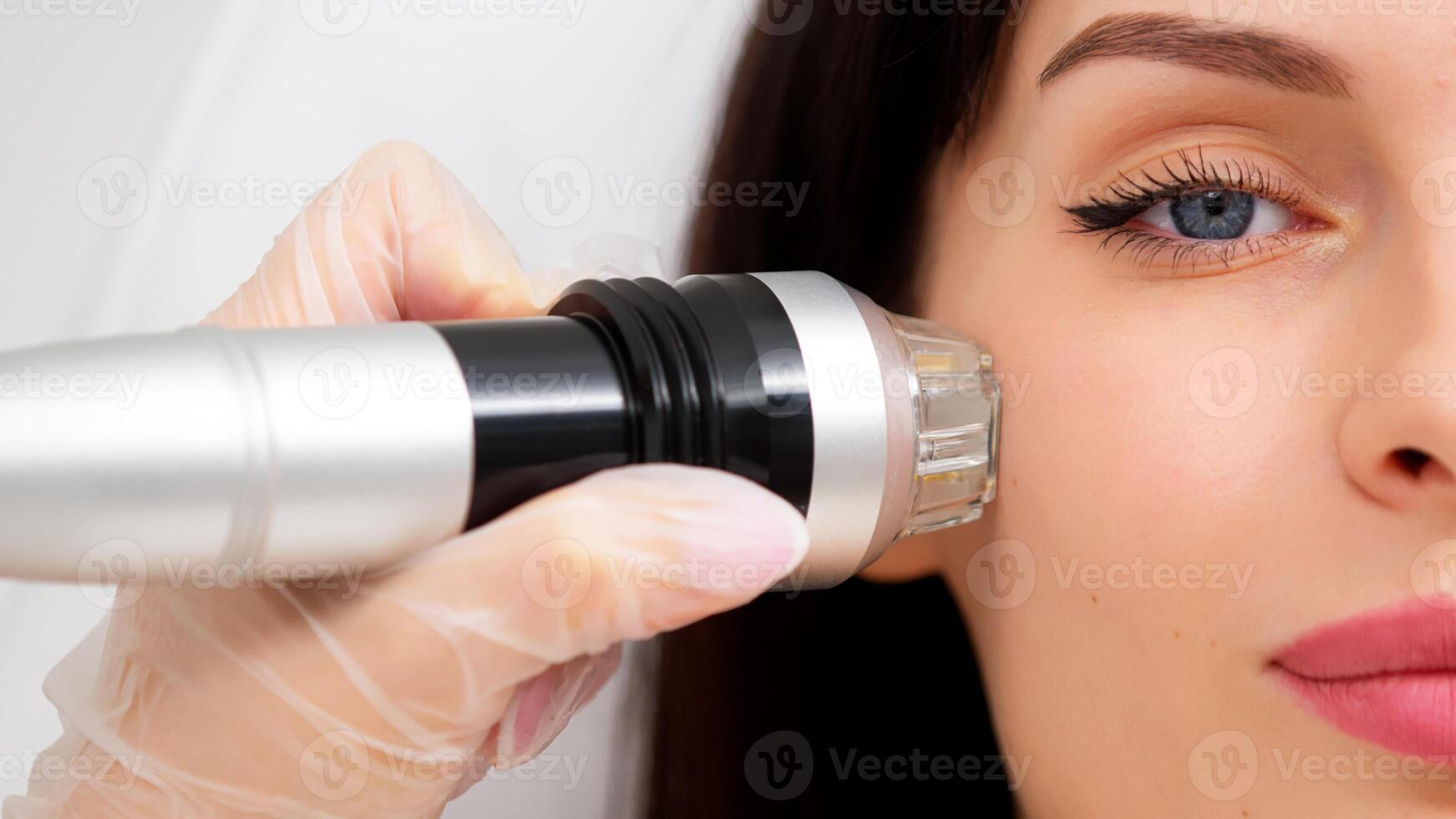 Close-up of a young woman undergoing fractionated radiofrequency treatment for skin rejuvenation at a medical center. Ideal for demonstrating advanced cosmetic procedures photo