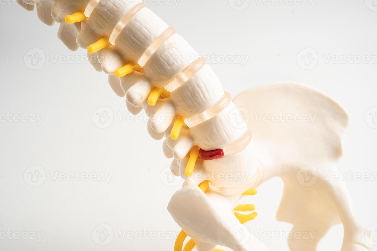 Lumbar spine displaced herniated disc fragment, spinal nerve and bone. Model for treatment medical orthopedic photo