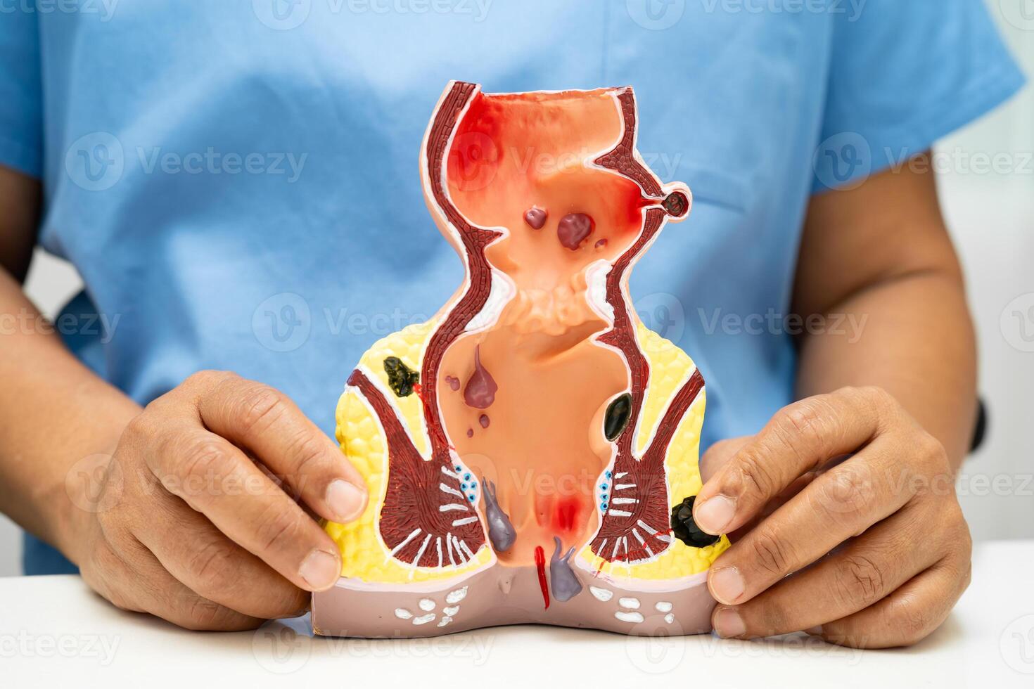 rectum and hemorrhoid human anatomy model at hospital, inflamed vascular structure. photo