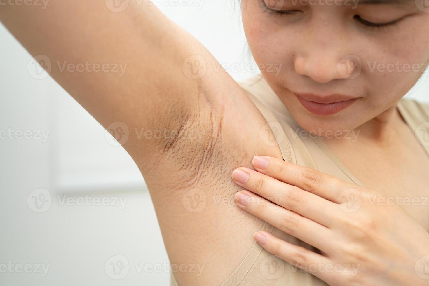 woman have problem black armpit skin care. photo