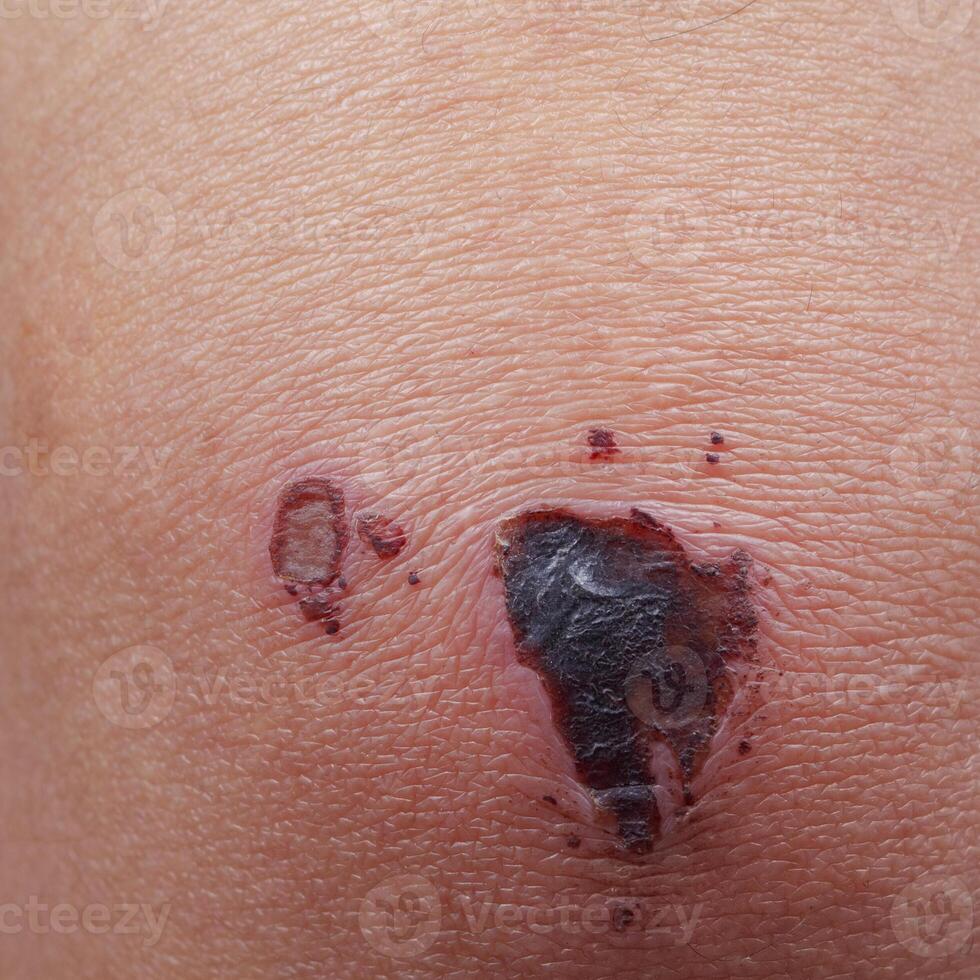 Wound on skin for pattern photo