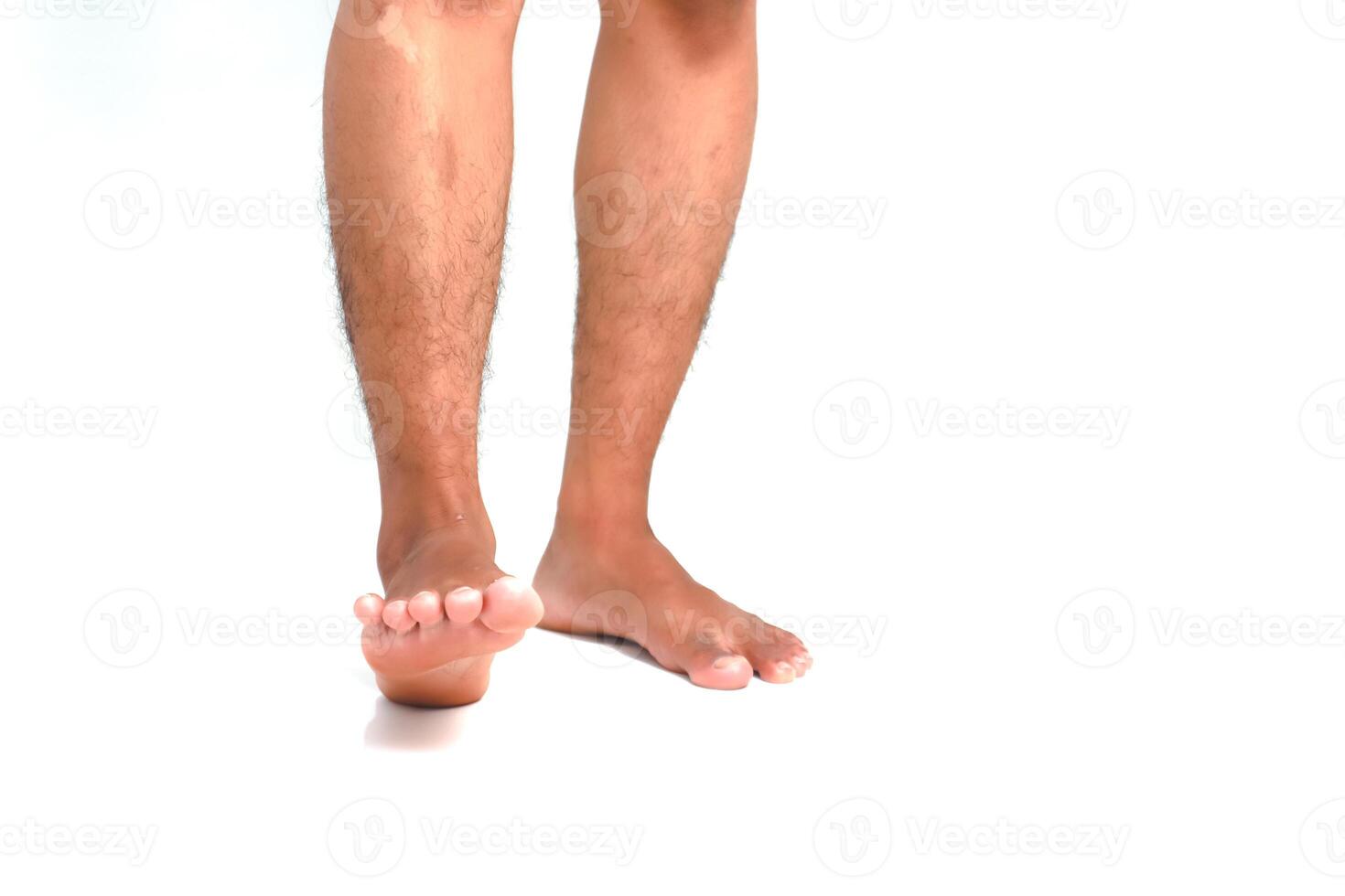 Man stands showing legs and feet on a white background for medical or health care concept showcasing skin or foot problems photo
