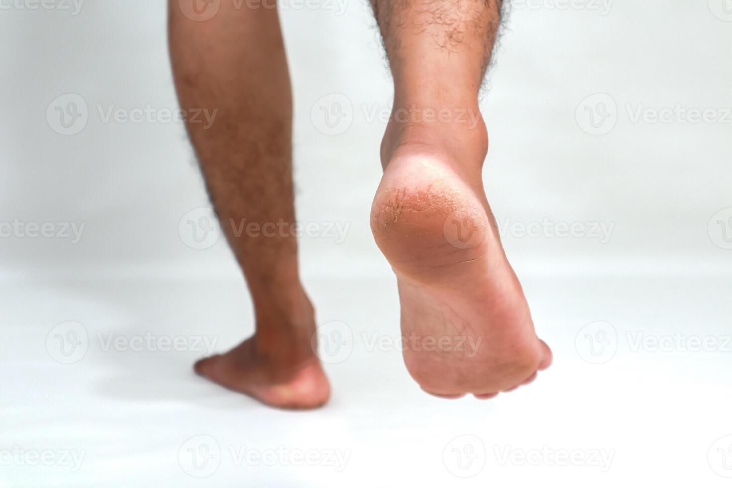 Close-up of Cracked Heels on Human Feet, Demonstrating Skin Condition Requiring Foot Care photo
