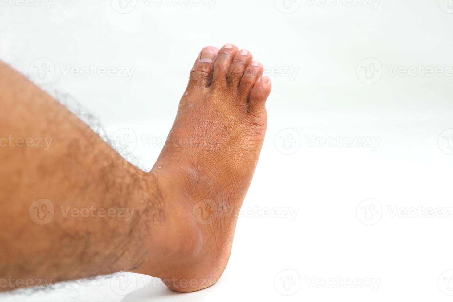 Close-up view of a male human foot with skin discoloration against white background photo