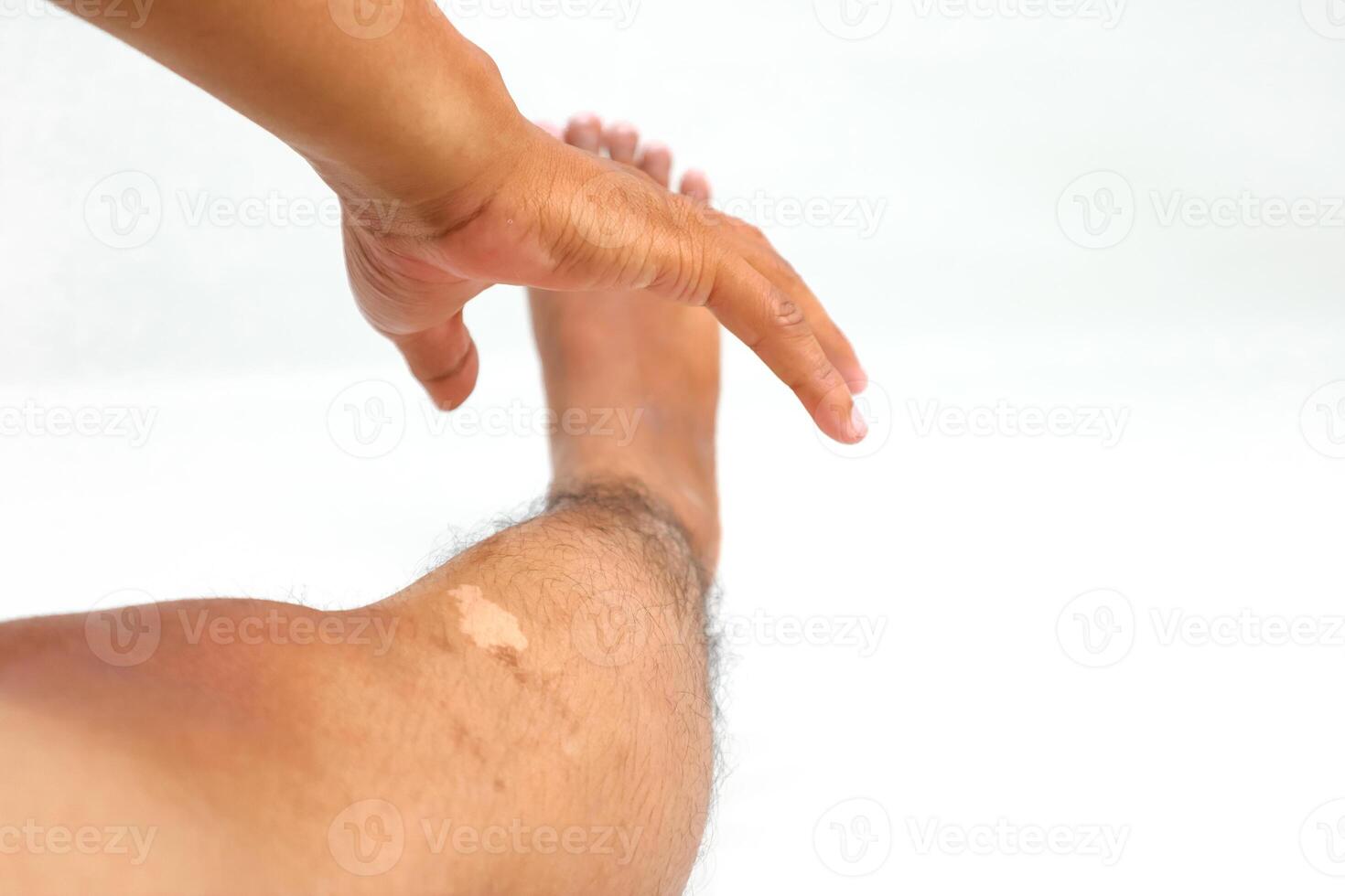 Close-up image of a hand examining the skin and hair of a leg with a light patch suggesting vitiligo photo