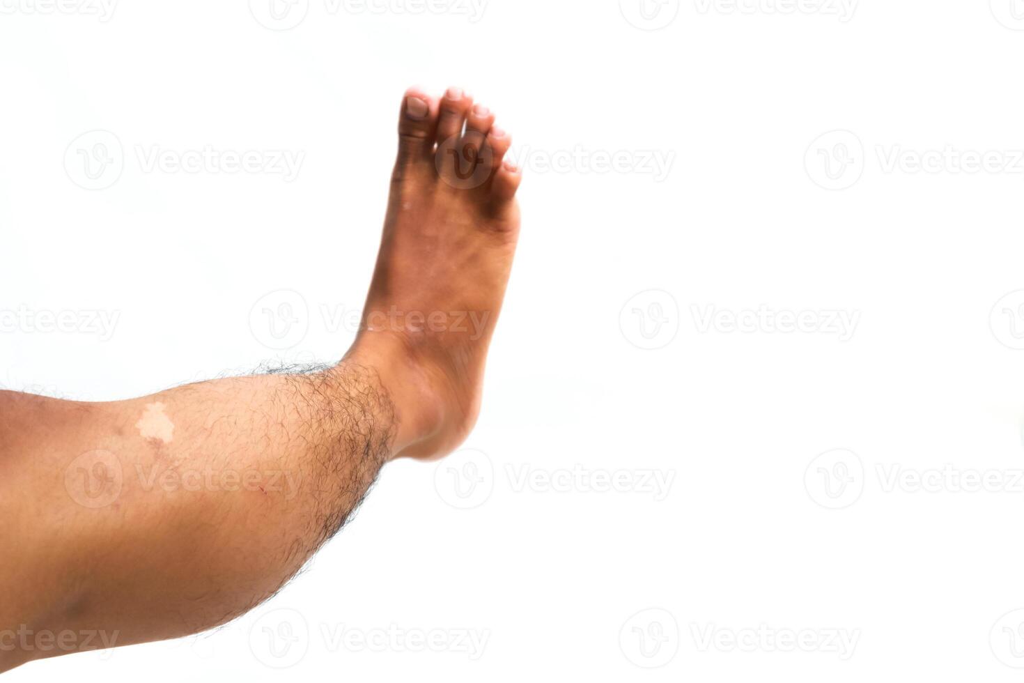 Isolated male foot with vitiligo skin condition raised on a white background photo