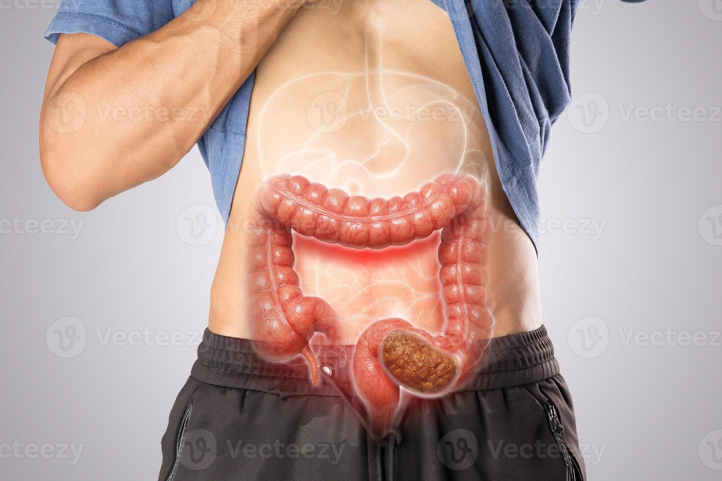 Medical illustration of constipated colon in human abdomen. Ideal for health and education. photo