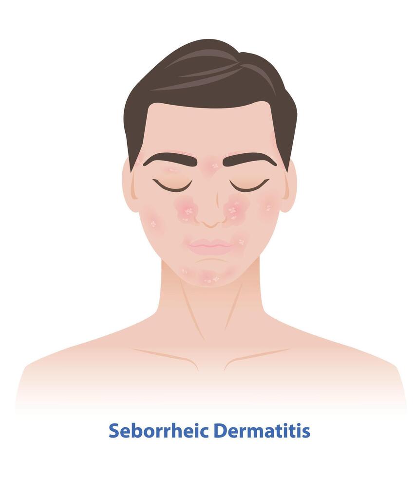 Seborrheic Dermatitis on man face illustration. Sebderm, inflamed skin, scaly patches, flakes over the oilier areas of the face, over the eyebrows, sides of the nose, beard area, ears, eyelids. vector