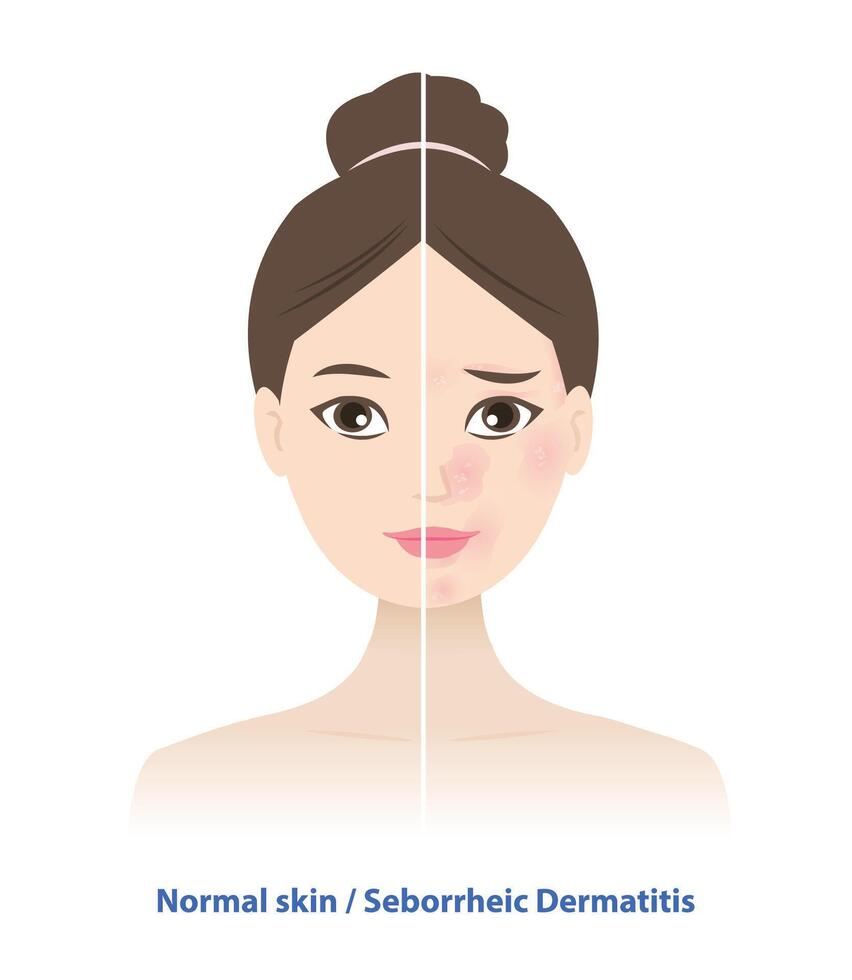 Comparison of normal skin and Seborrheic Dermatitis on woman face illustration. Sebderm, inflamed, red patches with white or yellow scale the face, sides of the nose, eyebrows, ears, eyelids. vector