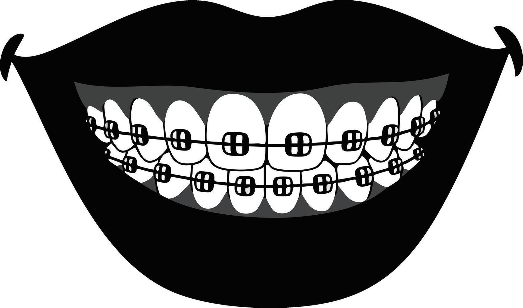 Smiling mouth with braces dental orthodontics teeth correction design illustration vector