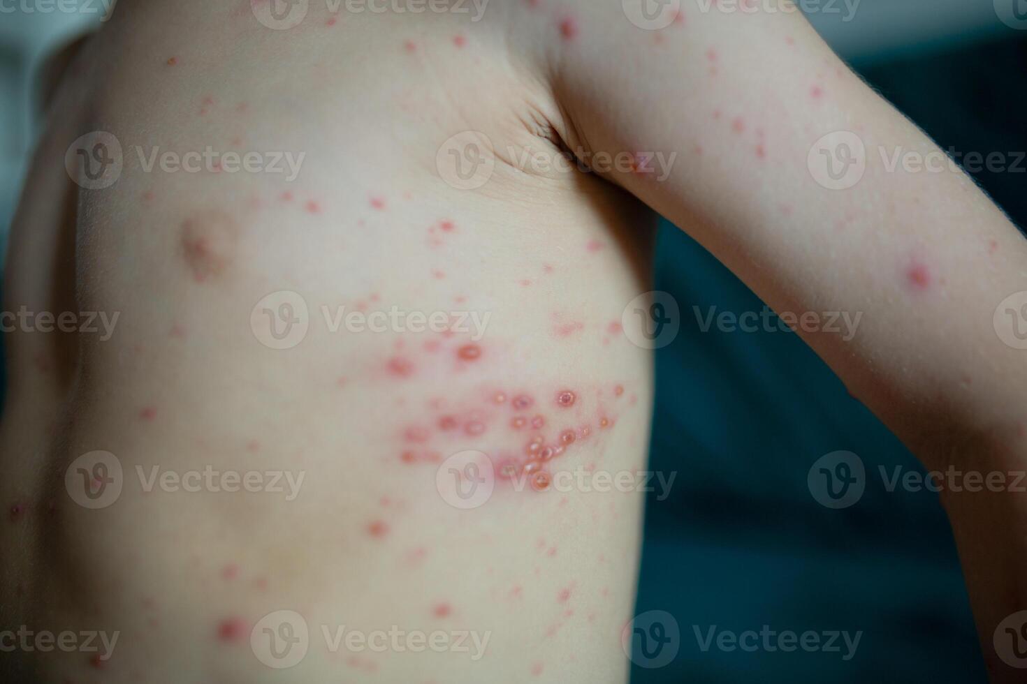 Child torso covered with chickenpox rash. Skin with red itchy blisters caused by varicella virus. Pediatric infectious photo
