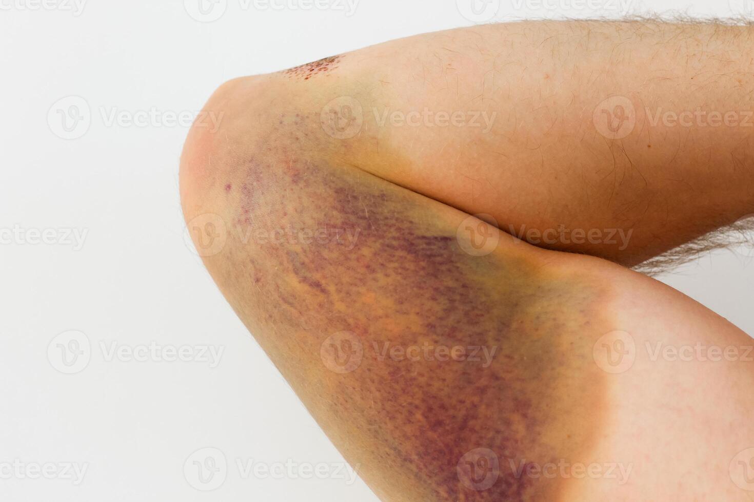 Bruised elbow showing signs of injury and healing over time photo