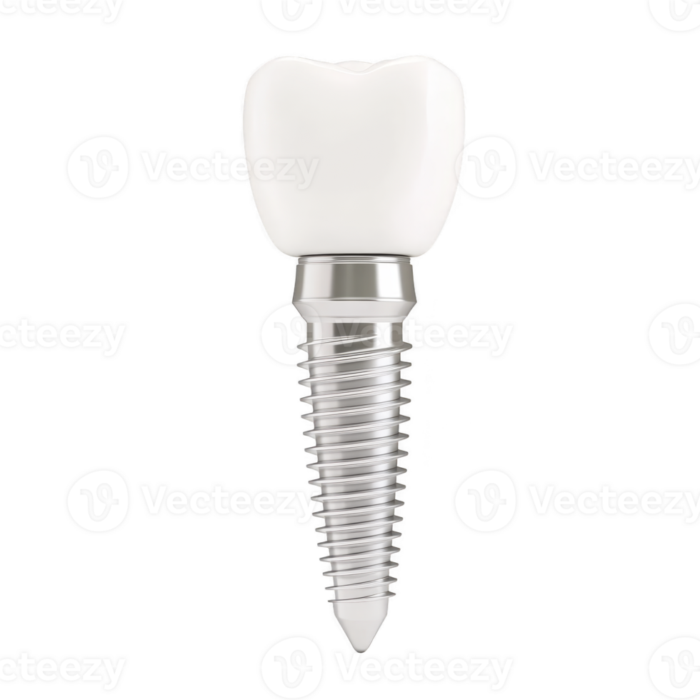 Dental implant with white crown and metallic screw is depicted, showcasing its structure and design. implant is isolated on transparency background, highlighting its details png