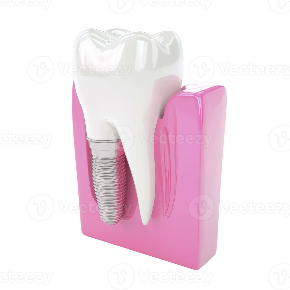 3D rendering of dental implant showcases realistic tooth model with metal implant embedded in pink gum tissue, illustrating modern dental procedures png