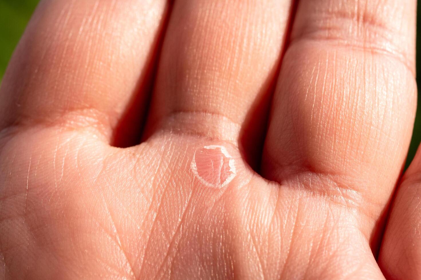 Skin condition close-up human hand medical indoor setting macro view healing process photo