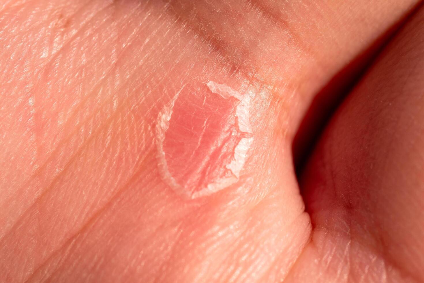 Skin care treatment for hand wounds home health image indoor close-up view healing process photo