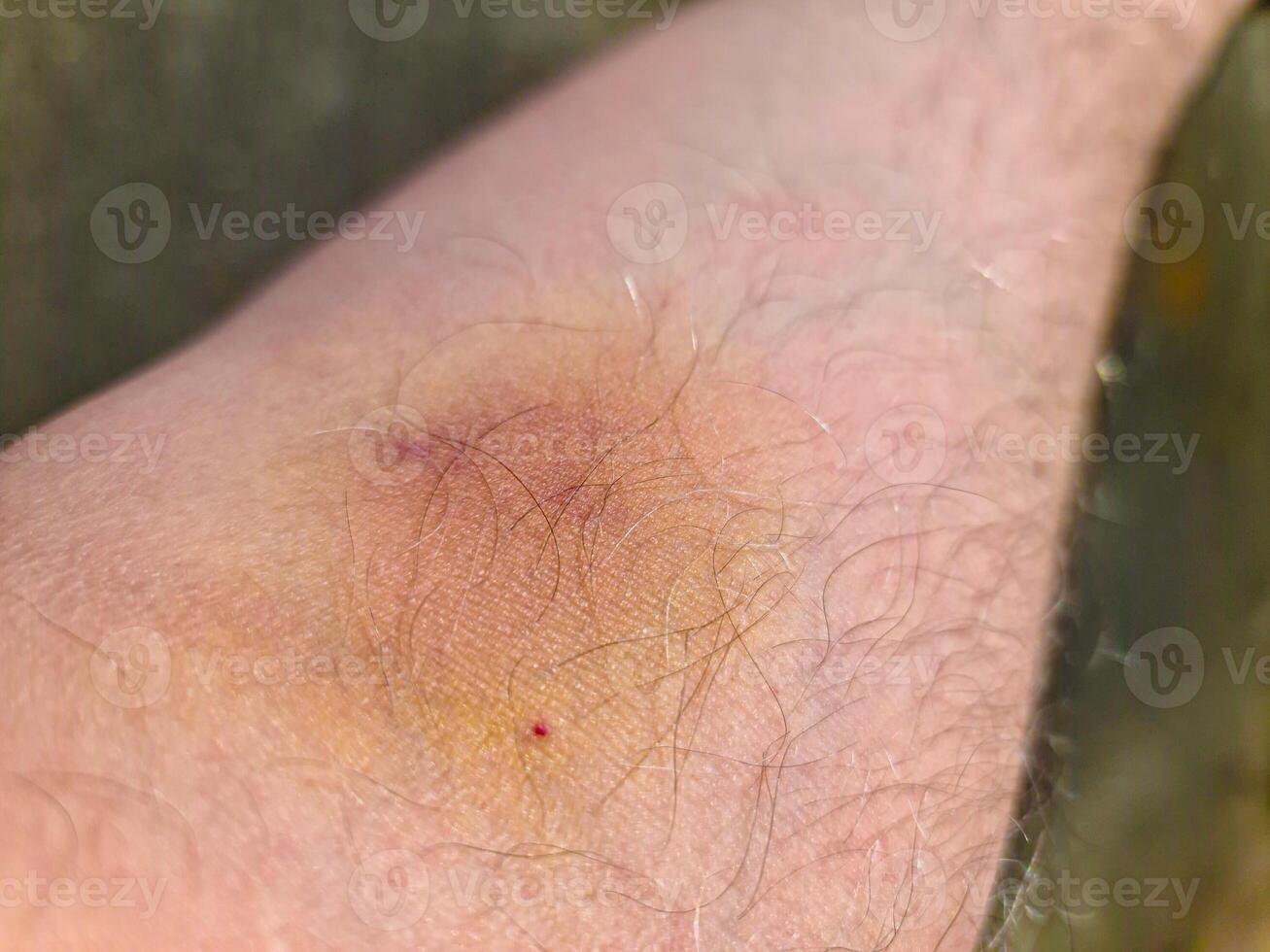 Large bruise forming on hairy arm after injection photo