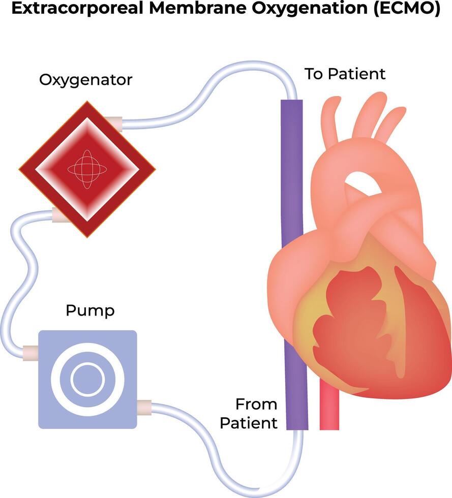 Extracorporeal Membrane Oxygenation ECMO System Diagram vector