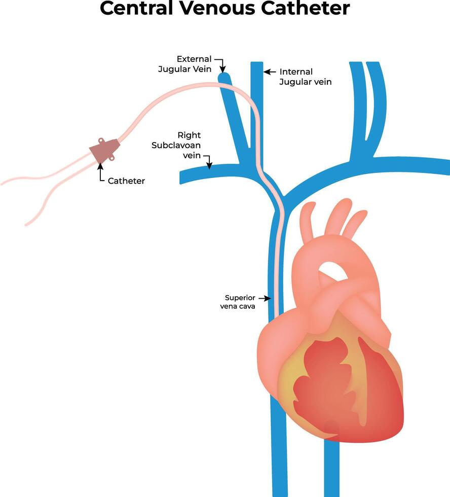 Central Venous Catheter Placement Anatomy Diagram vector