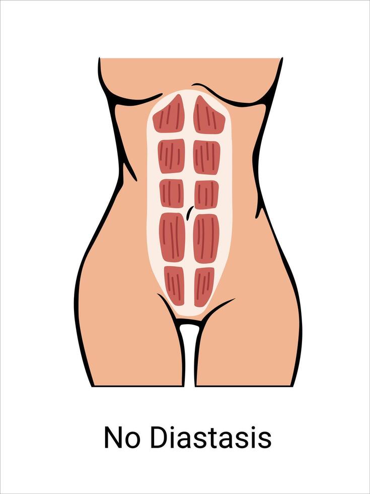 No Diastasis in a woman before and after pregnancy. The anatomy of a Woman. Woman muscular corset, body part. illustration vector