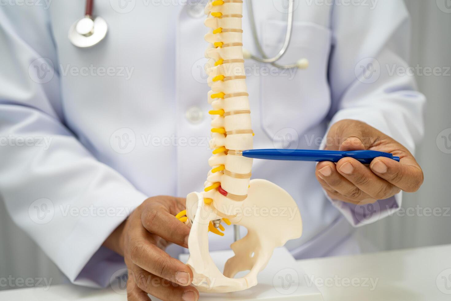 doctor holding spinal nerve and bone model, Lumbar spine displaced herniated disc fragment for treatment medical in the orthopedic photo
