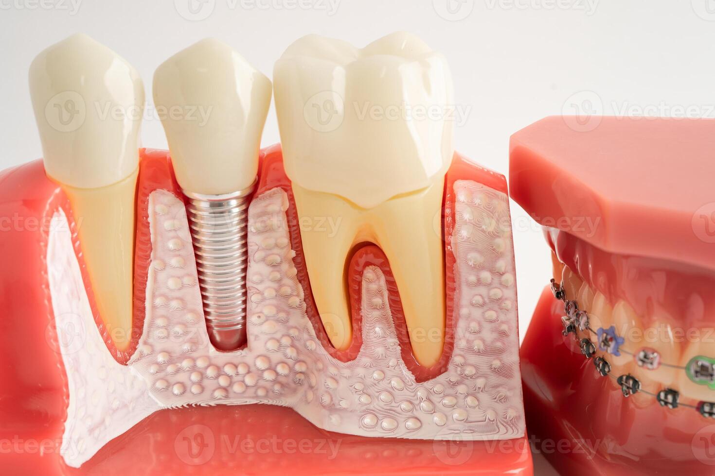 Dental implant artificial tooth roots into jaw, root canal of dental treatment, gum disease teeth dentist dentistry. photo