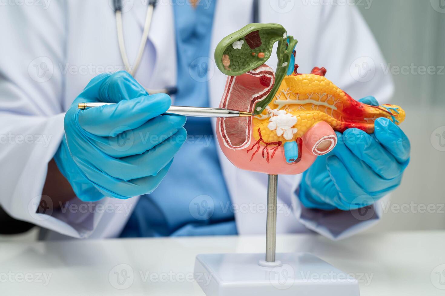 Pancreatitis pancreatic cancer, doctor with pancreas gallbladder photo