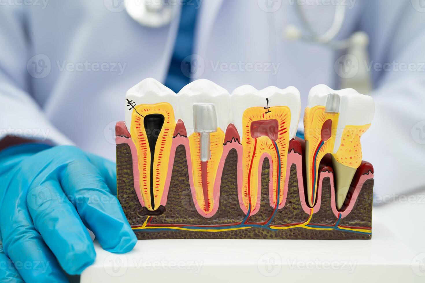 Dental implant artificial tooth roots into jaw, root canal of dental treatment, gum disease teeth dentistry. photo