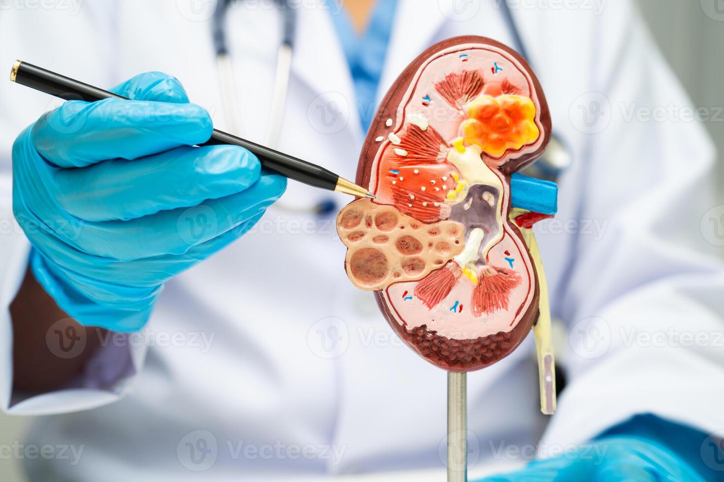 Chronic kidney disease, doctor urinary photo