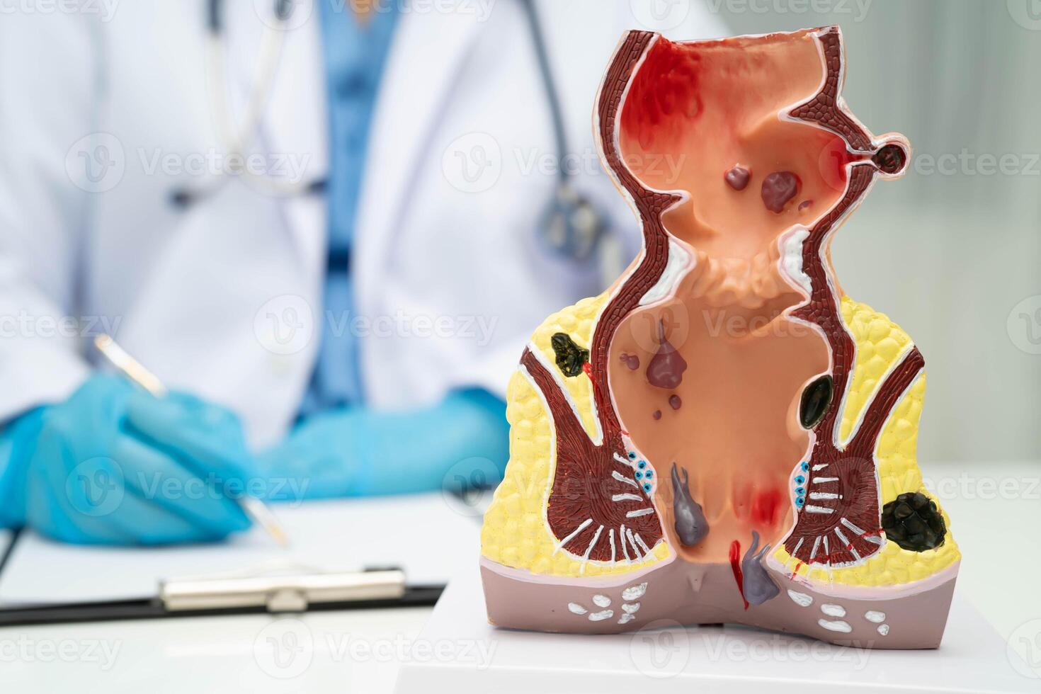 doctor rectum and hemorrhoid human anatomy model at hospital, inflamed vascular photo