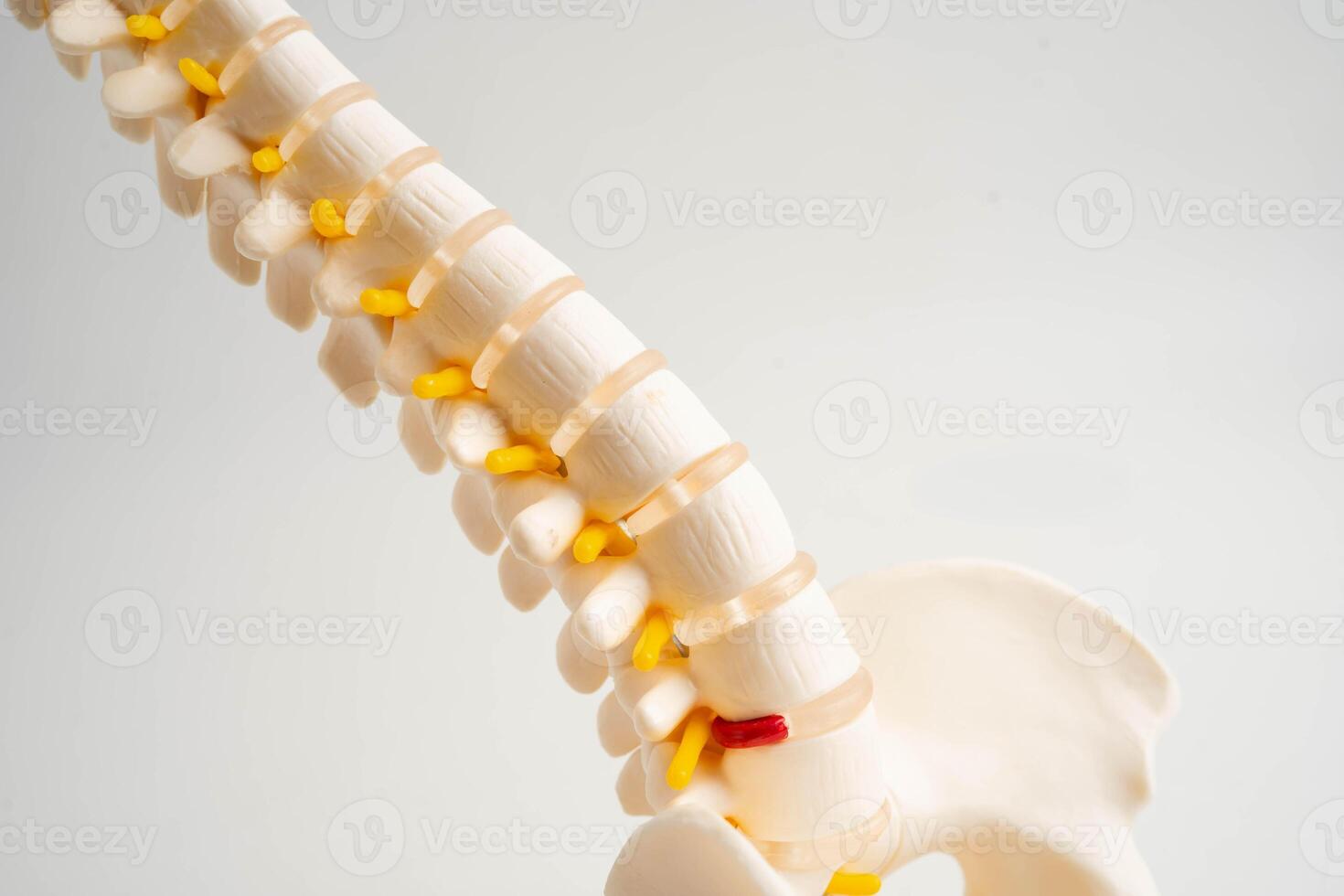 Spinal nerve bone, Lumbar spine displaced herniated disc fragment, Model for treatment medical in the orthopedic department. photo