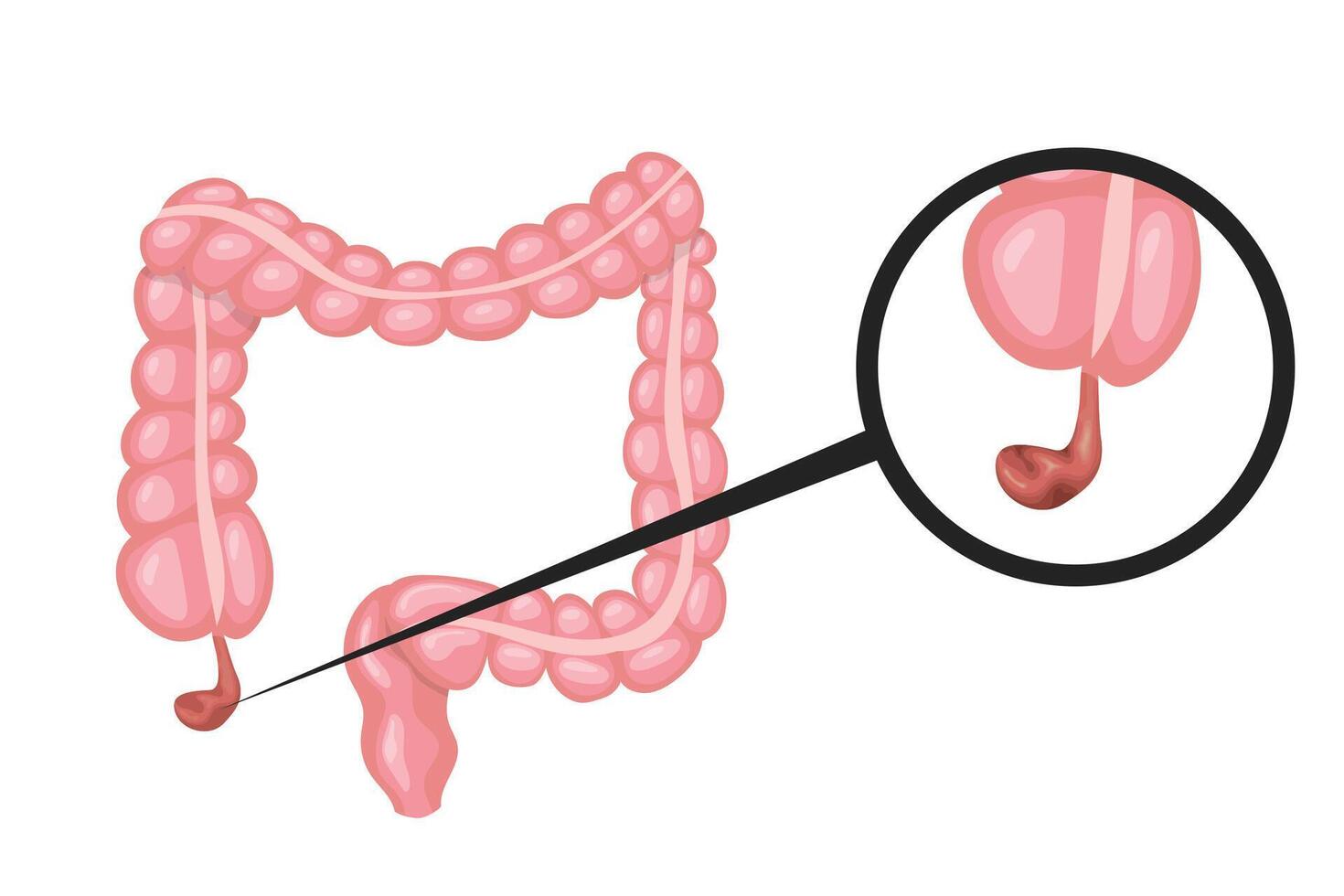 Magnifying glass showing appendicitis in human intestines vector