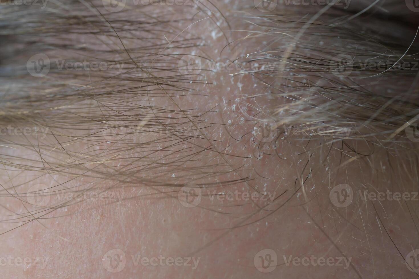 Close up of dry, irritated scalp with visible flakes. Concept of scalp health, dermatology, dandruff, haircare, discomfort and sensitive skin condition. photo