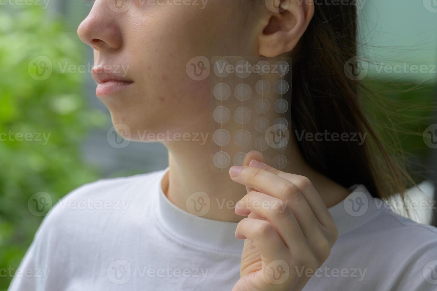 Close up of a young woman holding a transparent pimple patch set near her acne prone cheek. Concept of skincare, healing, dermatology, facial care, youth and gentle cosmetic treatment. photo