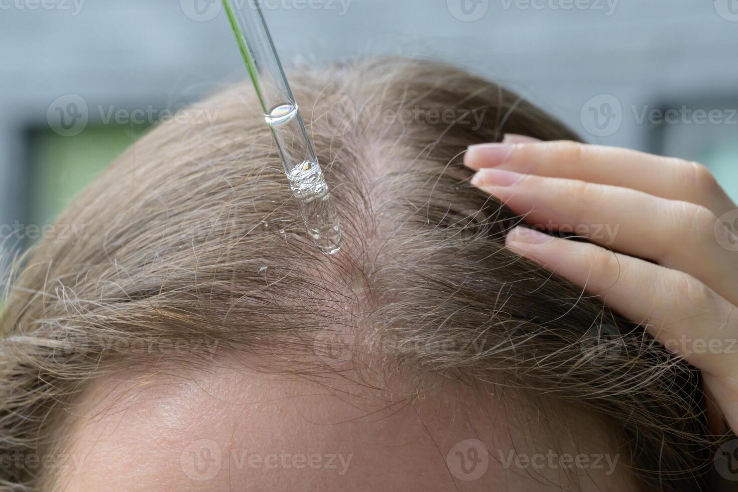 Close up of a person applying serum to dry irritated and itchy scalp with a glass dropper. Concept of skincare, scalp treatment, hydration, self care and hair health with focus on roots and moisture. photo