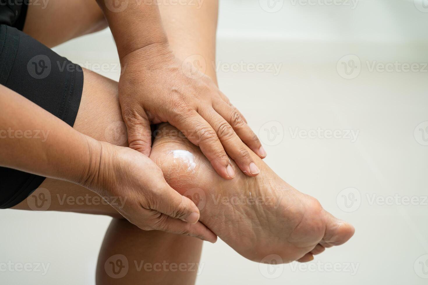 woman care feet cracked and dry heel skin cream at home. photo