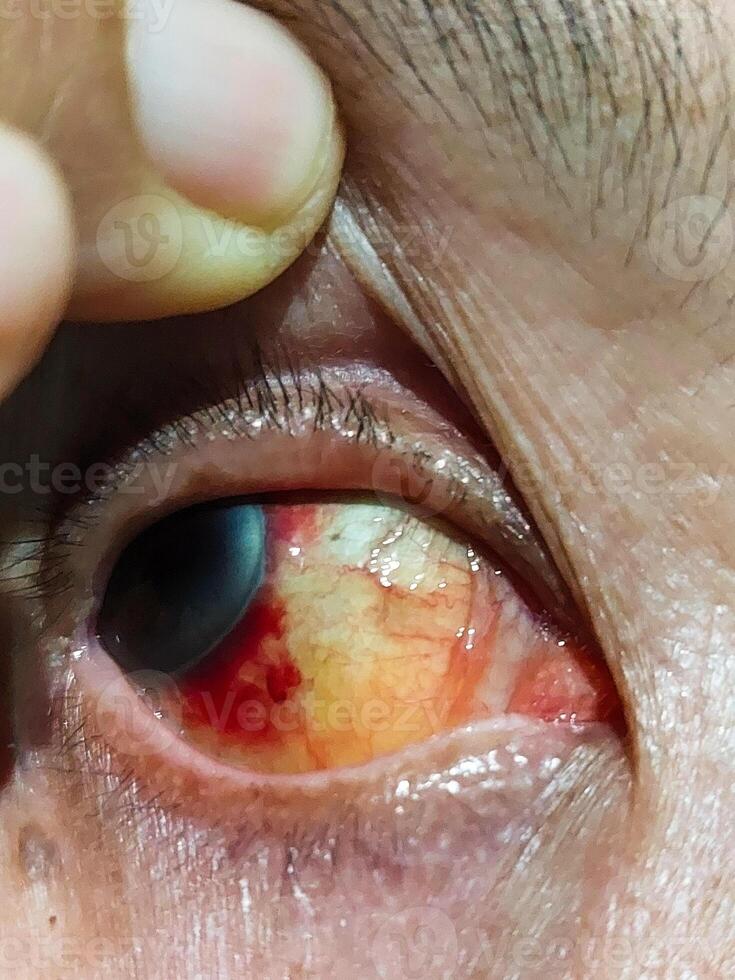 Eye Showing Subconjunctival Hemorrhage with Red Blood Vessels photo