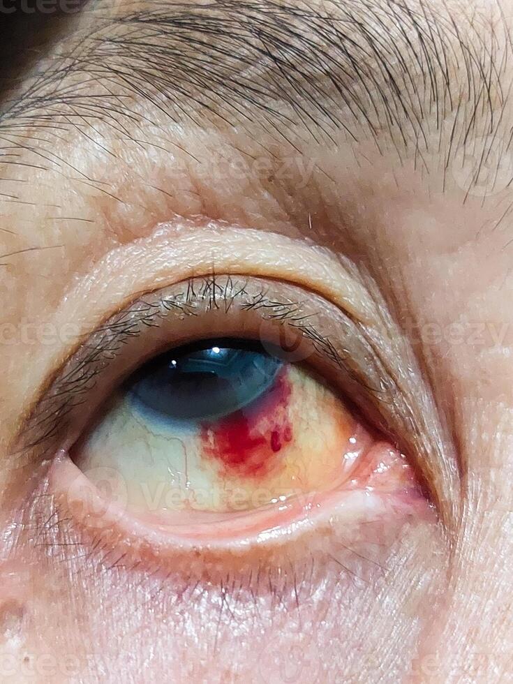 Close-Up of Eye Showing Subconjunctival Hemorrhage with Red Blood Vessels photo