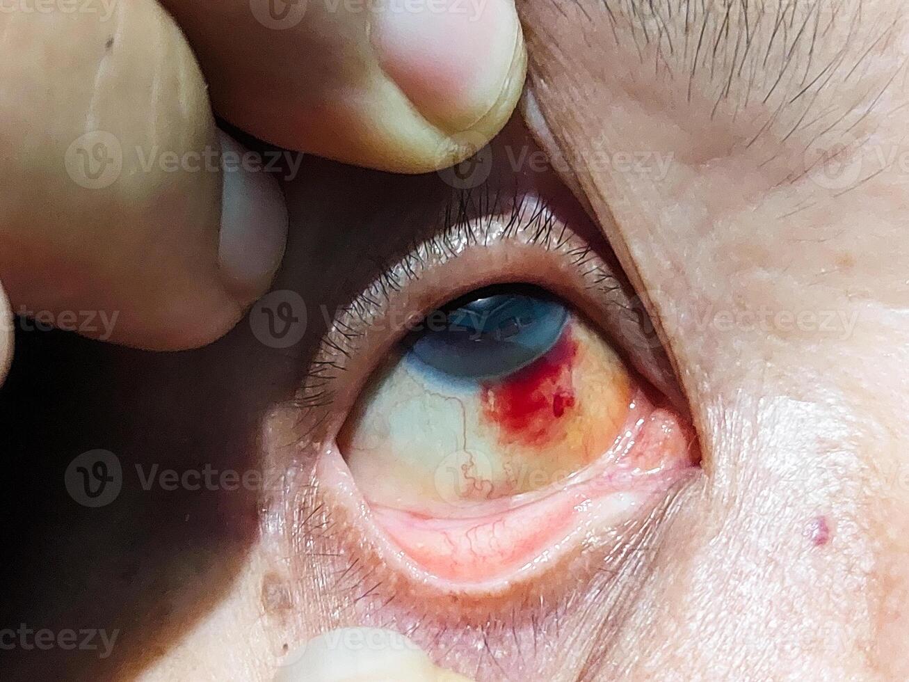 Close-Up of Woman Eye Showing Subconjunctival Hemorrhage with Red Blood Vessels photo